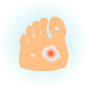 Диабетическая стопа