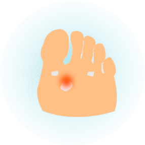 Натоптыши и мозоли