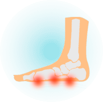 Плоскостопие