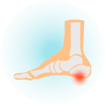 Пяточная шпора