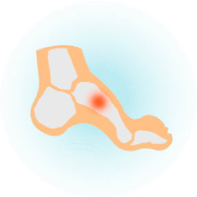 Высокий свод стопы